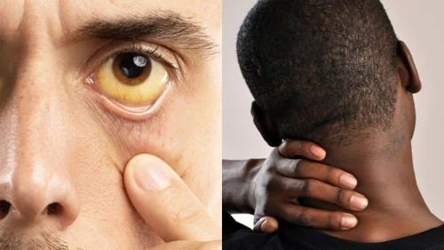 Julho Amarelo e Verde alertam para hepatites virais e câncer de cabeça e pescoço