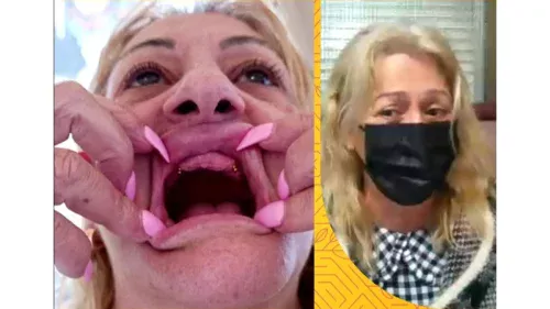 O verdadeiro motivo por trás do pesadelo de uma espanhola que viajou para fazer os seios e perdeu todos os dentes