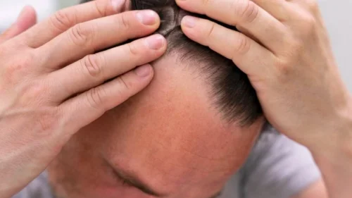 Alimentação rica em nutrientes pode ajudar no combate à calvície, apontam estudos