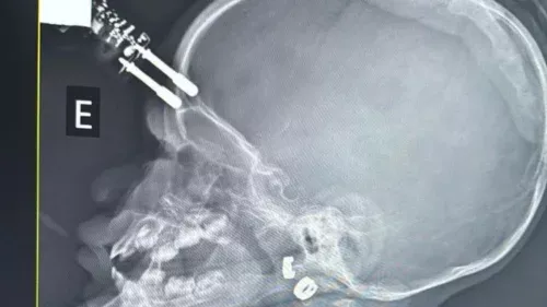 Bebê de 1 ano passa por cirurgia após cair com carregador cravado na testa em MG