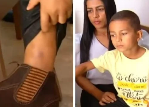 Menino Sobrevive a Picada de Jararaca em Palmas e Relata o Momento do Acidente