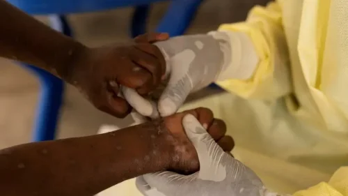 Primeiro caso da nova cepa da Mpox é registrado em São Paulo