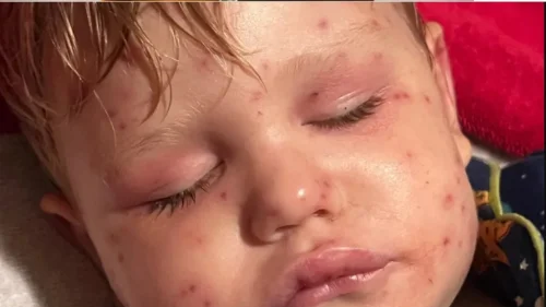Menino de 2 anos tem falência múltipla de órgãos após 150 picadas de vespas