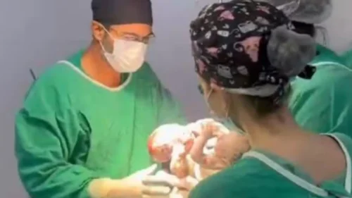 Primeiros gêmeos siameses de 2026 nascem em parto de alta complexidade em Goiás