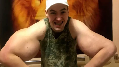 Fisiculturista russo conhecido como 'Popeye' pode perder os dois braços